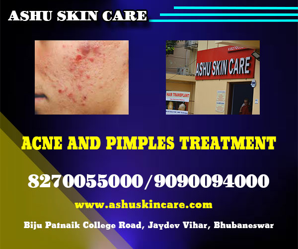 best acne and pimples treatment clinic in bhubaneswar near me - ashu skin care